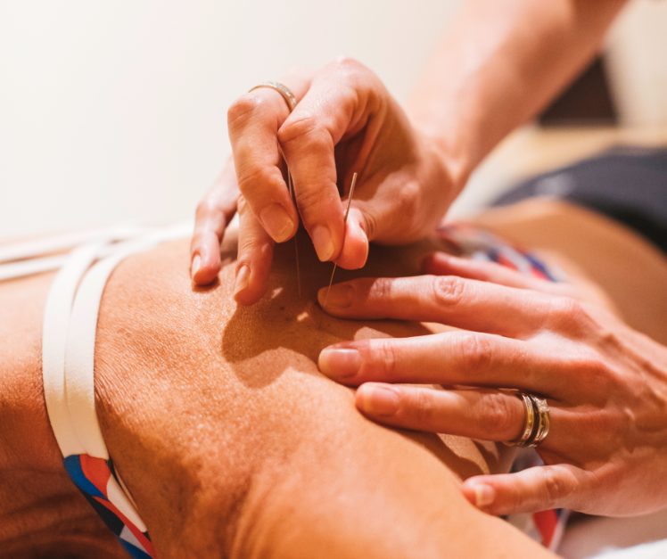 dry needling physiotherapy